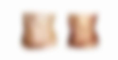 疤痕疙瘩怎么修复较好？医美激光治疗精准祛疤，恢复肌肤平滑，还你自信美丽！ 