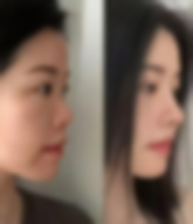 怎么能让单眼皮变双眼皮？医美手术和双眼皮贴大揭秘，助你快速拥有迷人双眼皮！ 