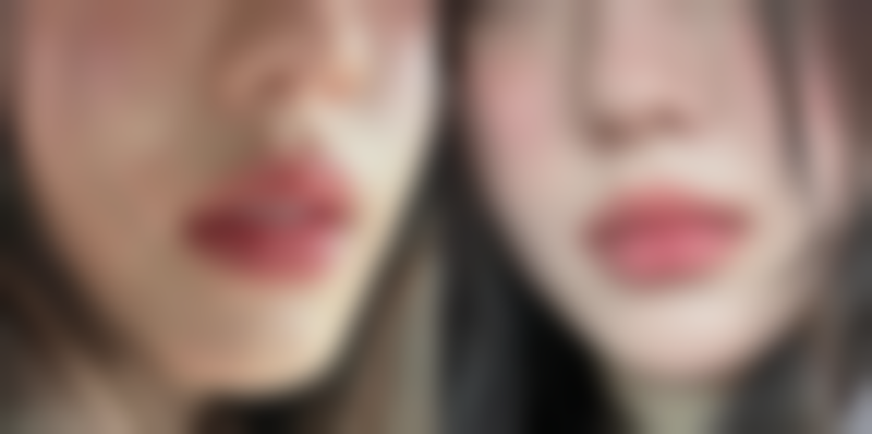 冷热敷交替对全切双眼皮修复有什么作用