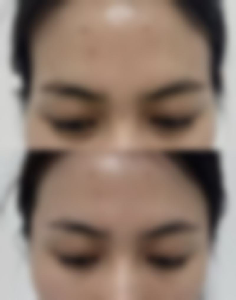 让单眼皮变双眼皮术前要做哪些准备