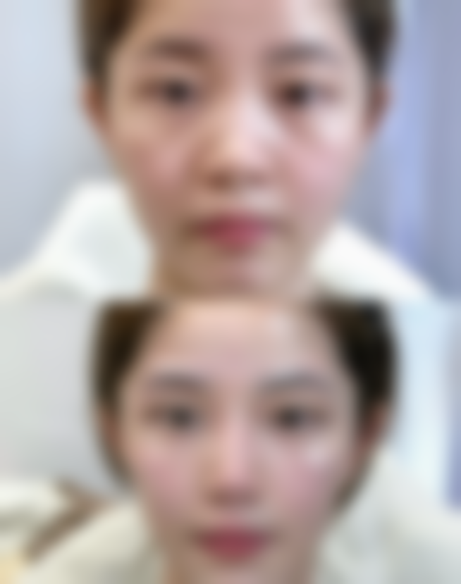 修复疤痕疙瘩后如何护理