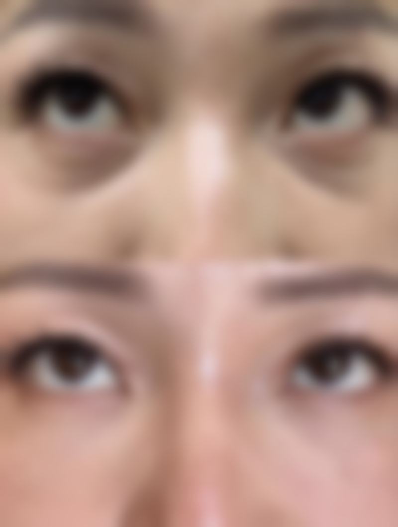 三点定位法让单眼皮变双眼皮值不值