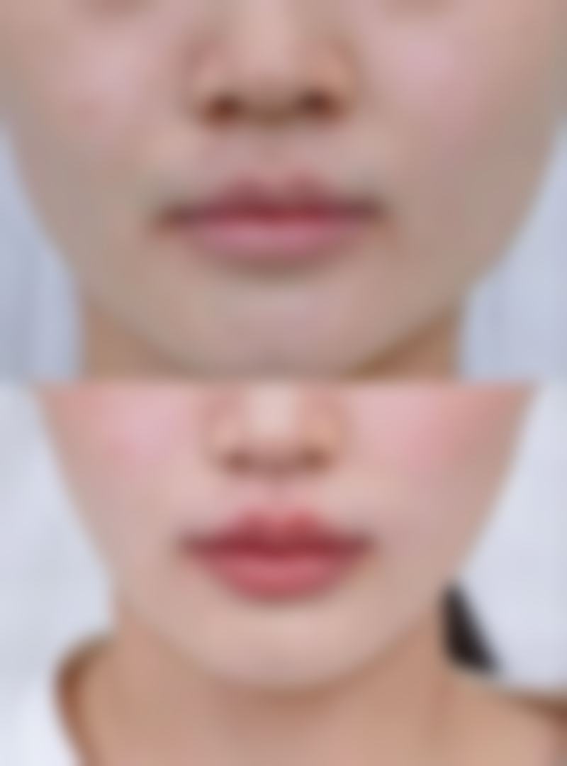 隆鼻后鼻孔内软骨突出修复手术靠谱吗