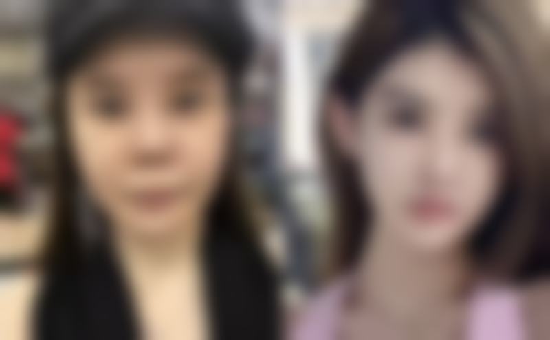 张升医生之北京百达丽医疗美容篇：真实实例