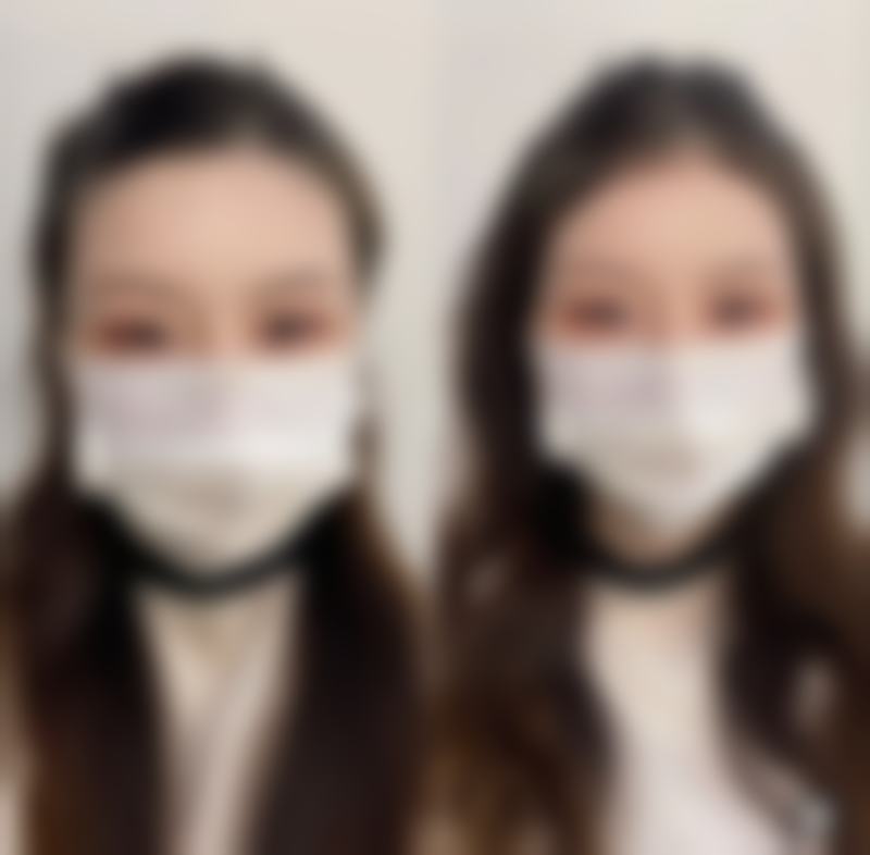 激光紧缩阴道3200元适合吗