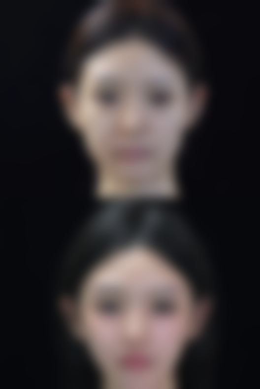 做完激光去眼袋和射频抗皱后眼睛有眼袋和皱纹还会复发吗