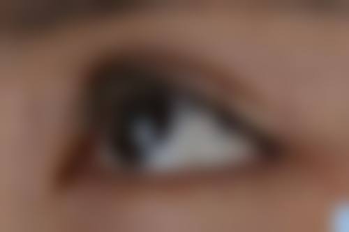 德国热熔眼袋技术能真的实现无痕去眼袋吗