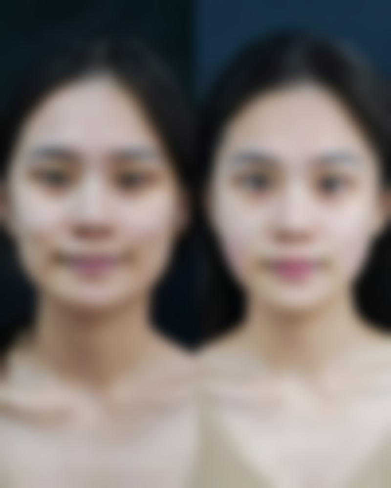 进口优质玻尿酸隆鼻3800元靠谱吗