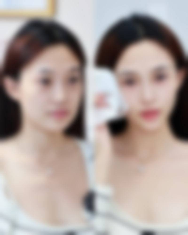 玻尿酸填充隆鼻适合所有人吗