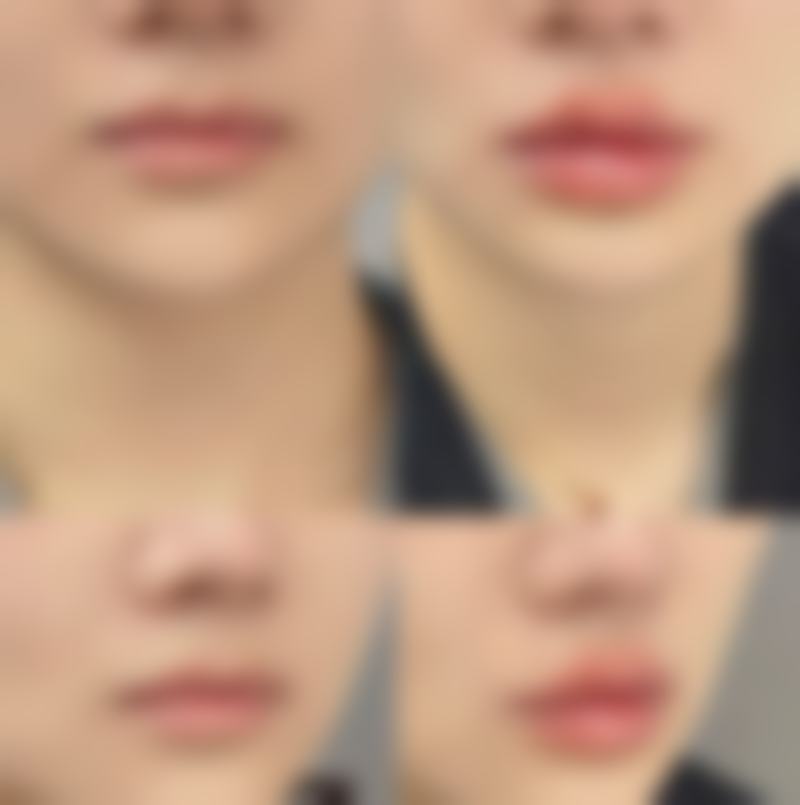 双眼皮开眼角 6 个月到 1 年完全修复自然值不值?