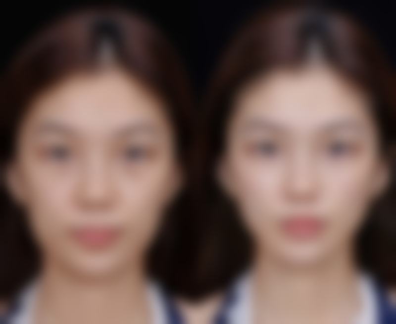 双眼皮开眼角多久恢复？一般7-10天消肿，1-3个月基本恢复，6个月到1年完全恢复自然！ 