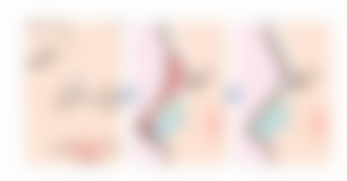 瘦脸针和下巴注射一起打有什么注意事项