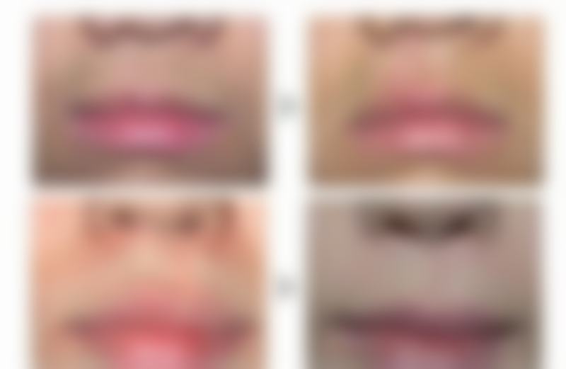 肿泡眼割双眼皮效果怎么样？术后眼睛灵动有神，颜值提升显著，让你轻松拥有迷人电眼！ 