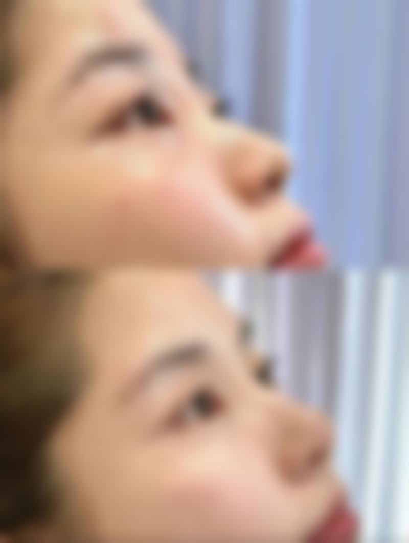 双眼皮开扇是什么样子？带你揭秘自然灵动的开扇双眼皮，宛如天生，让你美出新高度！ 