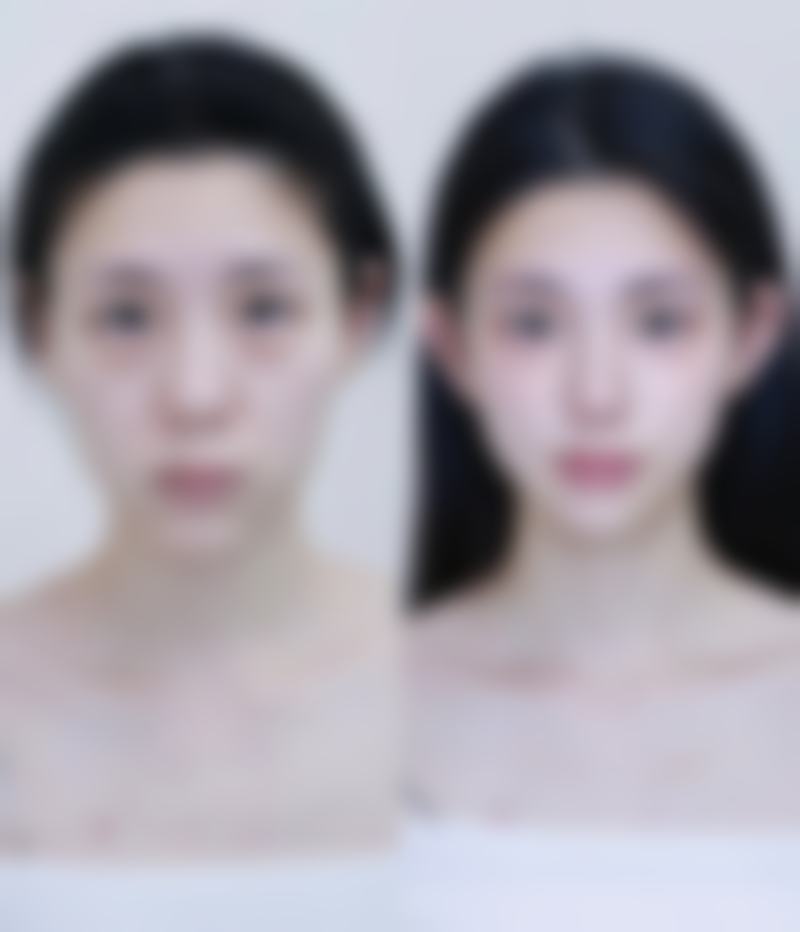 肿泡眼割双眼皮能让眼睛变得灵动有神吗