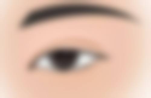 自体脂肪填充眼袋成效保持时间和年龄有关吗