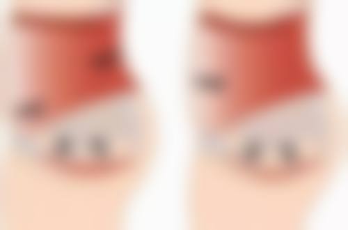 去除眼袋和眼角细纹选择哪种医美方法值不值