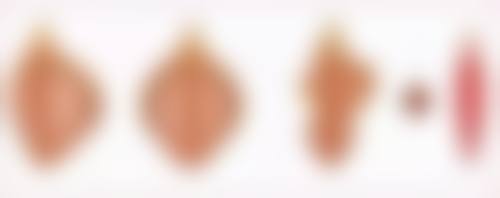 如何选择适合自己的双眼皮手术方式？