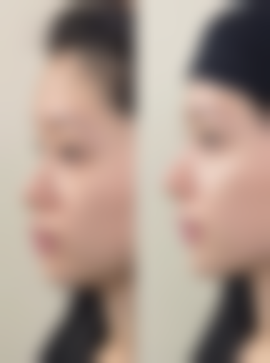 医美去除眼袋和眼角细纹适合所有人吗