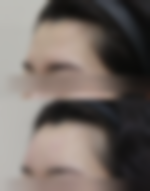 假体取出还能继续做假体隆胸吗？答案是能！了解取出后再隆胸的条件、流程与优势，重塑完美胸型！ 