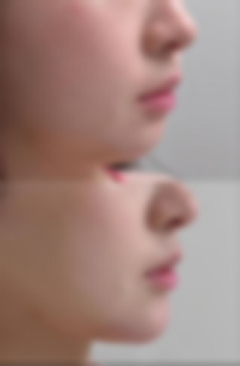 医美去除眼袋和眼角细纹靠谱吗