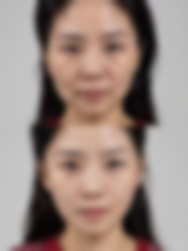 选择肉毒素还是玻尿酸除皱针怎么判断？