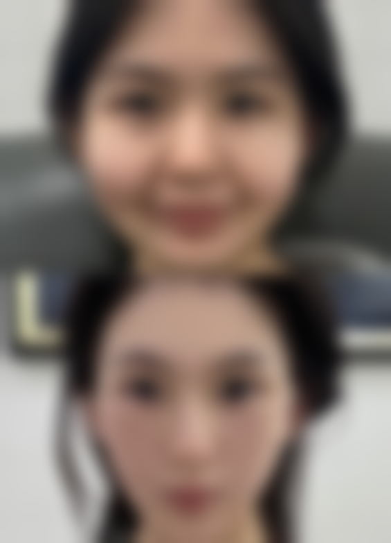 做完双眼皮吃西红柿对修复怎么样