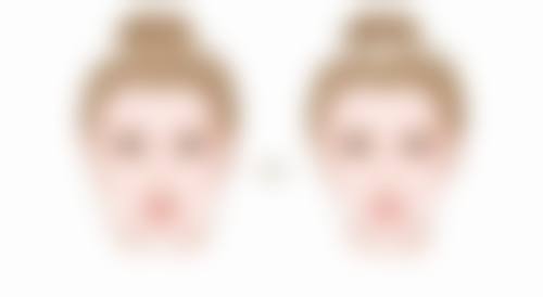 三岁宝宝缝针疤痕激光治疗成效怎么样?