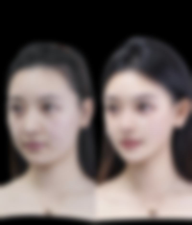 汕头汕美（华美）医疗美容医院赵四海医生真实实例