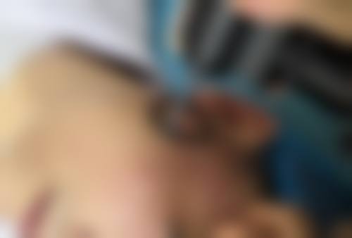 用骨粉隆鼻成效怎么样