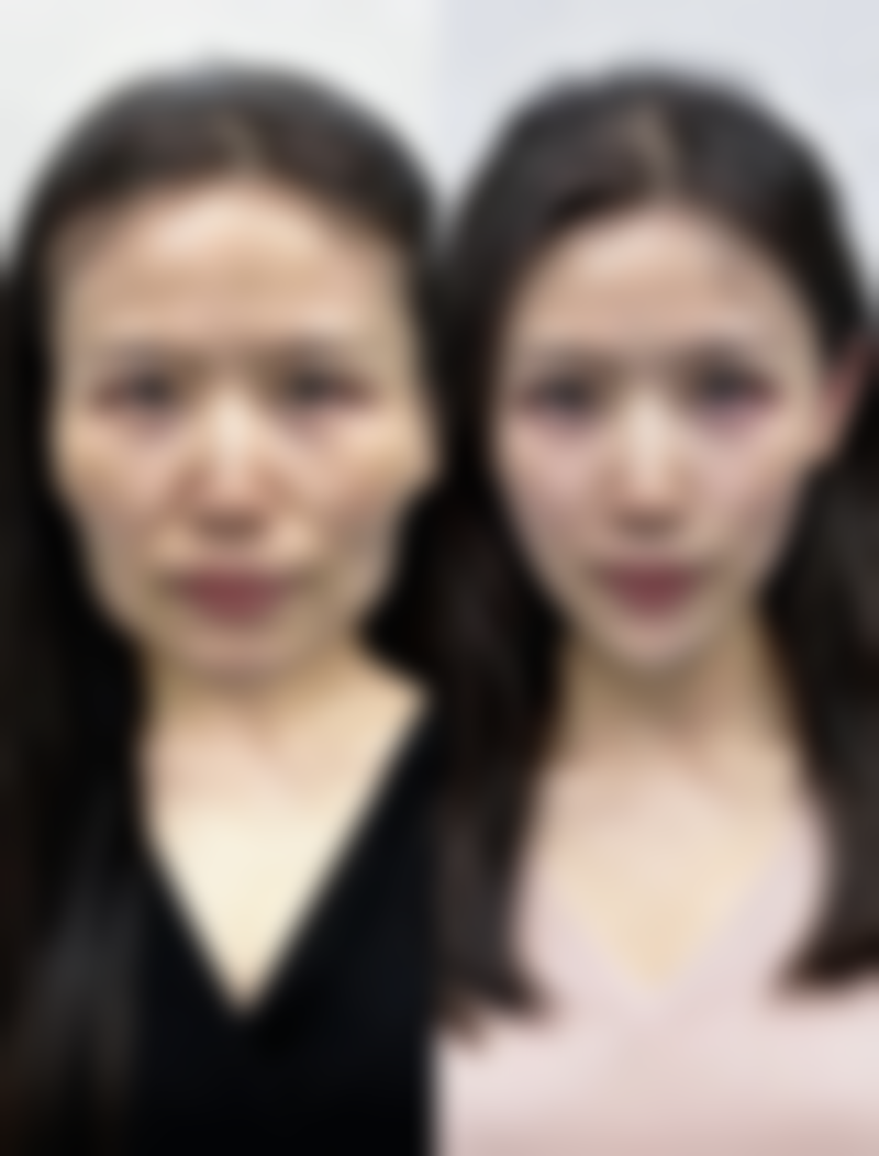 治疗疤痕增生后如何护理