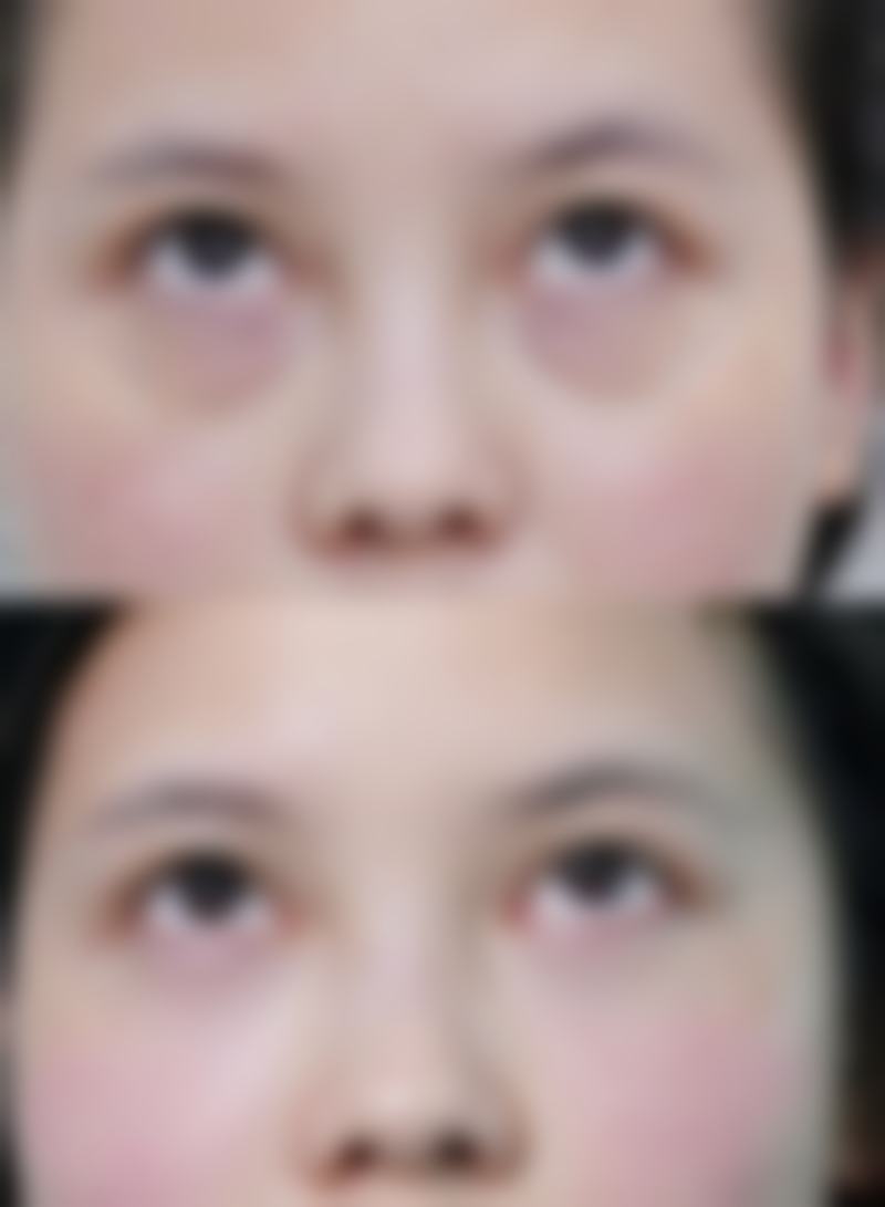 自体脂肪填充眼袋靠谱吗