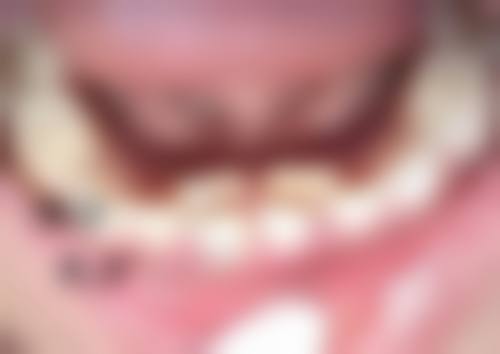 双眼皮割毁了怎么办？别慌！权威医美专家教你三招快速修复，重拾明亮双眸不再难！ 