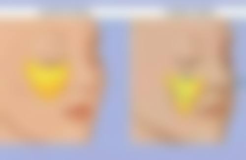 20岁医美去眼袋值不值