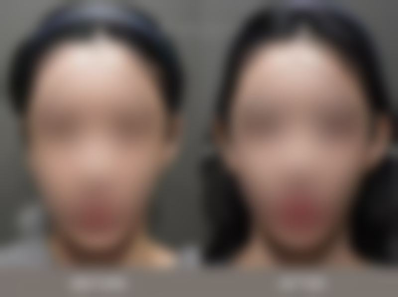 30岁做去眼袋手术有哪些优势