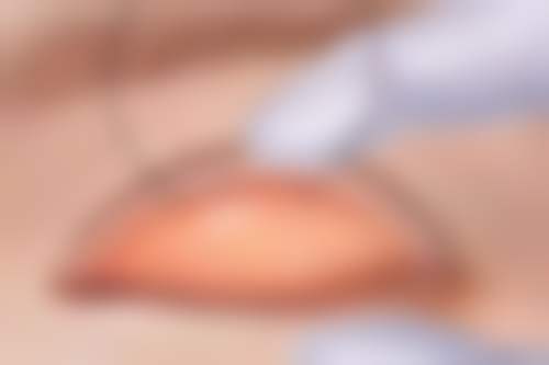 不同隆胸手术方式修复时间对比