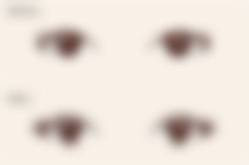 微晶磨皮适合去除双眼皮白色疤痕吗