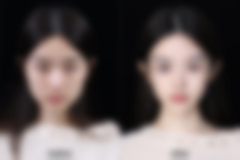 隆胸手术修复时间受哪些因素影响