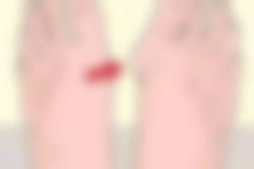 烫伤出现疤痕增生激光治疗值不值