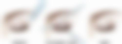 烫伤出现疤痕增生日常护理重要吗