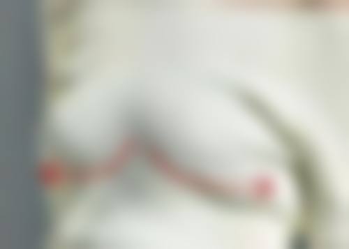 如果眼袋手术疤痕增生超过6个月还未修复该怎么办