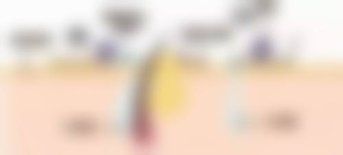 怎样护理能加快眼袋手术疤痕增生的修复