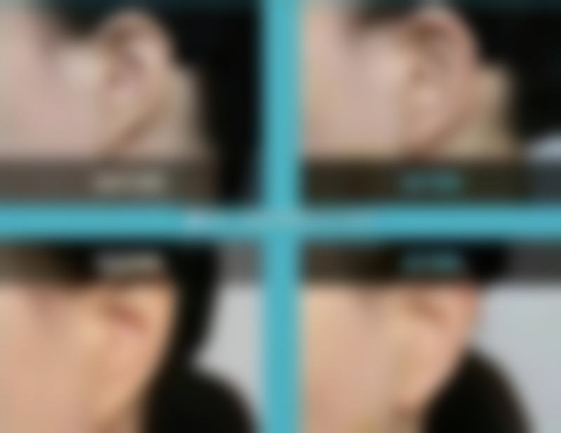 种头发移植毛囊的操作靠谱吗