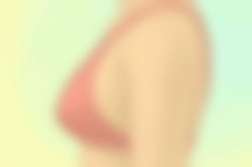 取出假体隆胸全麻有什么优势