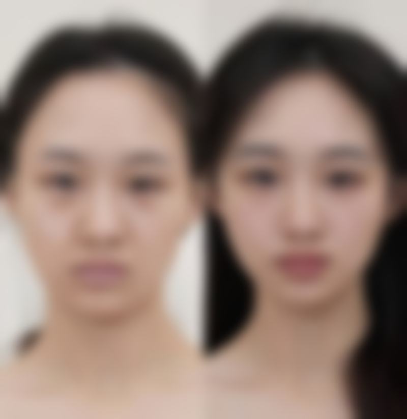 注射隆鼻的方法靠谱吗