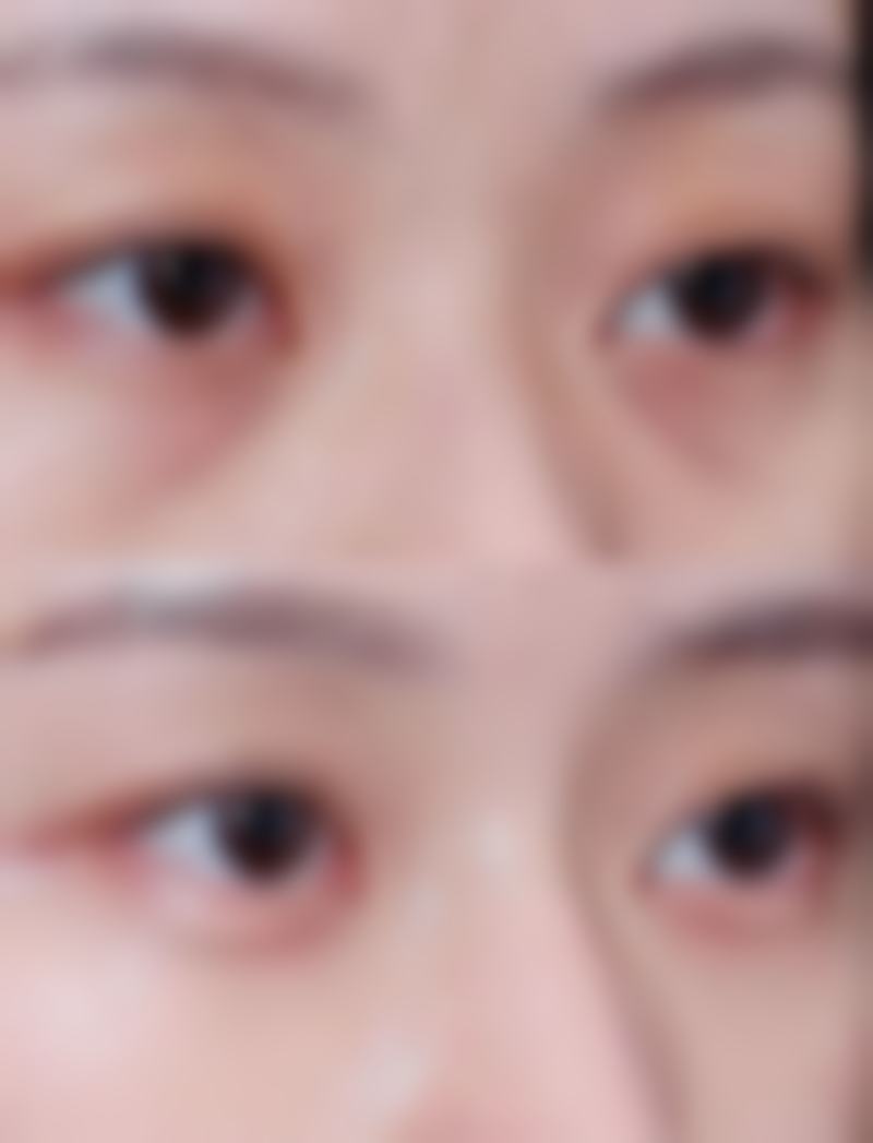 埋线双眼皮拆线后眼皮松弛的修复时间是多久