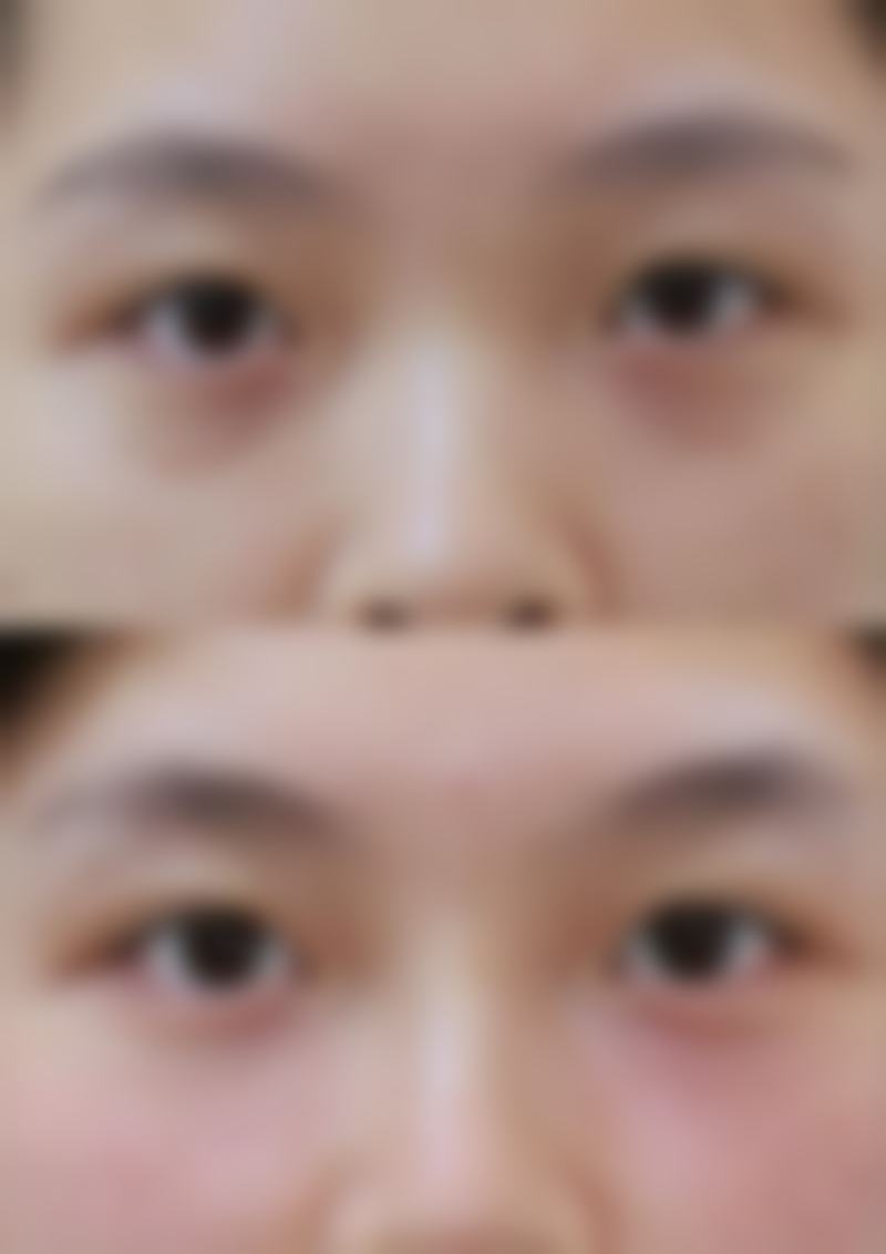 注射隆鼻的方法有什么优势