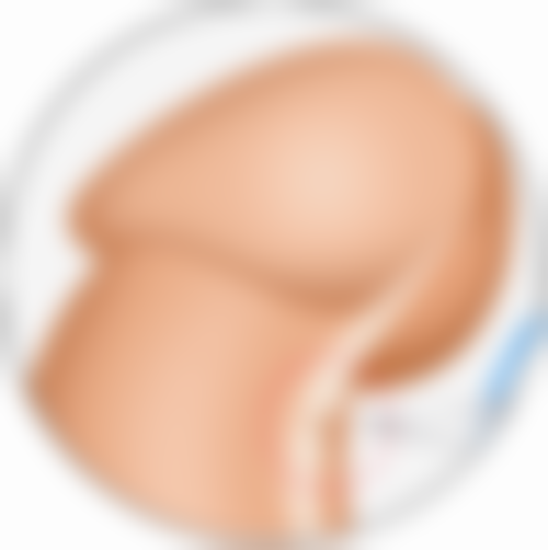 大腿吸脂修复适合所有人吗