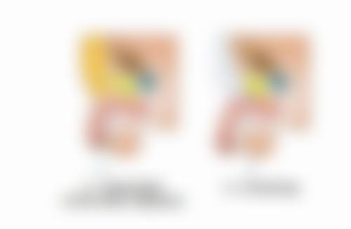 埋线双眼皮20天还不消肿怎么促进消肿