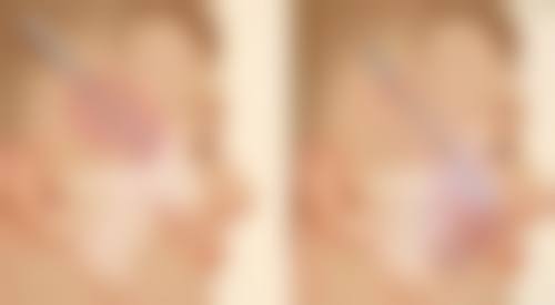 全切双眼皮四个半月修复成效怎么样